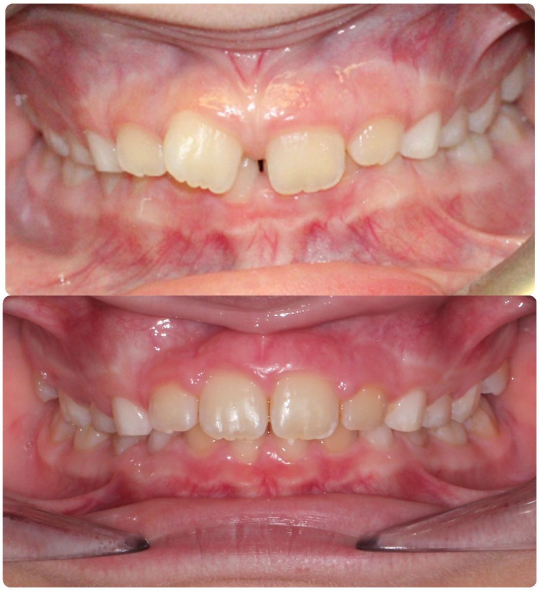 Before and After Douglas Dental Roseville CA